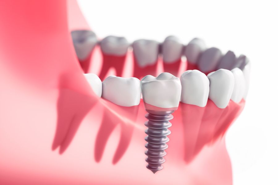 All You Need to Know About Dental Implants – Complete Guide